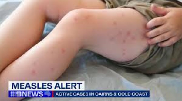9news_measles-alert.jpg